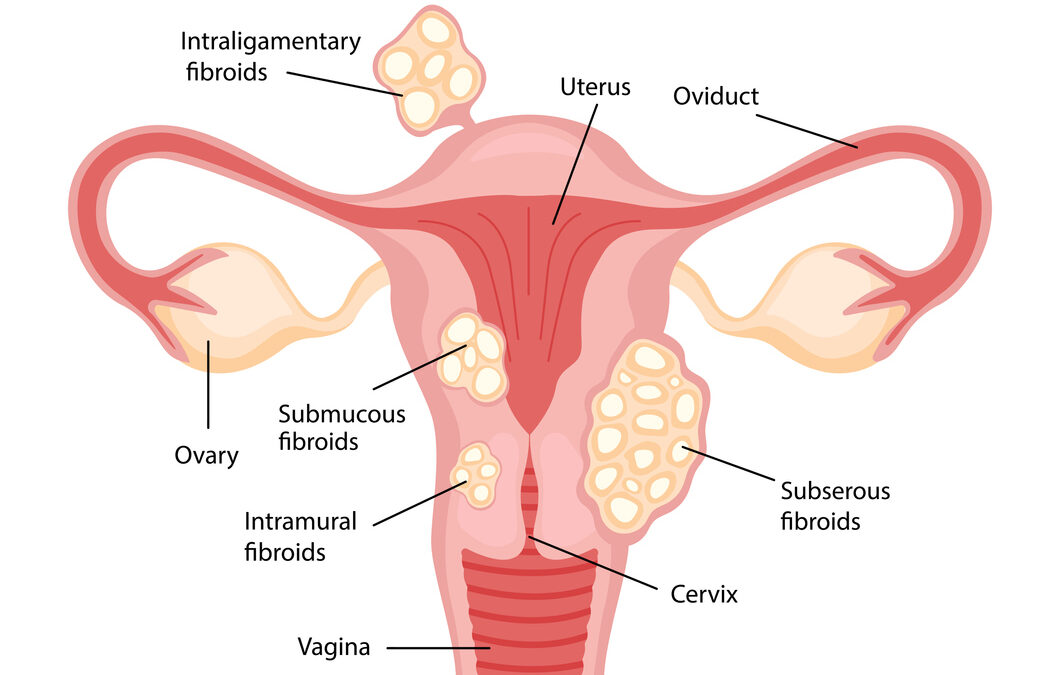 Everything you need to know when preparing for your uterine fibroid ultrasound
