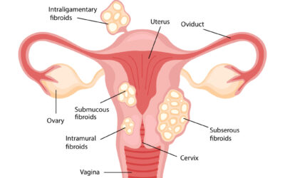 Everything you need to know when preparing for your uterine fibroid ultrasound