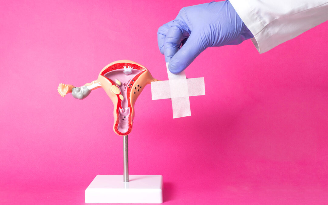 Best monitoring techniques for uterine fibroids
